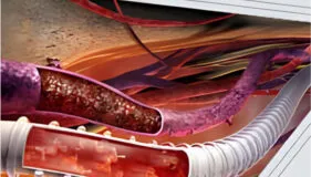 PTFE na Área de Medicina e Odontologia