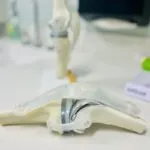 Artigo sobre prótese de PTFE - Megaflon